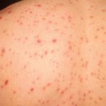 Gamot sa Bulutong: Mga Dapat Tandaan at Gawin Kung May Bulutong Ang Iyong Anak