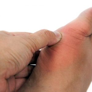 Gamot Sa Uric Acid: Basahin Ito Kung Pinahihirapan Ka Ng Gout!